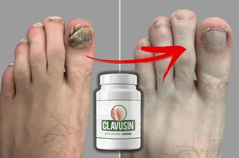 Clavusin Toenail Fungus Support Formula
